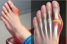 بیماری نقرس چیست ؟