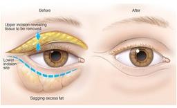 جراحی زیبائی پلک بلفاروپلاستی