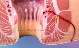 چرا لیزر فیستول مقعدی