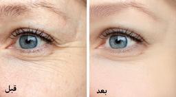 تزریق انواع پرکننده یا ژل به اطراف چشم