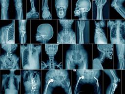 تشخیص بیماری پاژه استخوان