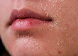 چگونه بیماری کلیوی بر پوست شما تأثیر می گذارد