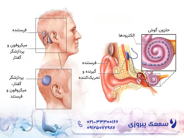 ناشنوایی مادرزادی