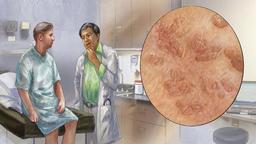 بیماری شایع زگیل تناسلی را با چه راهی درمان کنیم؟