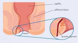 بیماری فیستول مقعدی چیست؟ معرفی بهترین مرکز جراحی