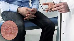 علائم و راه‌های انتقال زگیل تناسلی در مردان و زنان