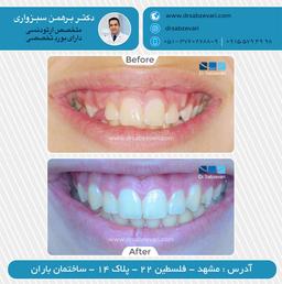 قبل و بعد از ارتودنسی