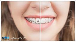 اقدامات قبل ارتودنسی