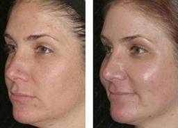 عکس قبل و بعد مزوتراپی صورت