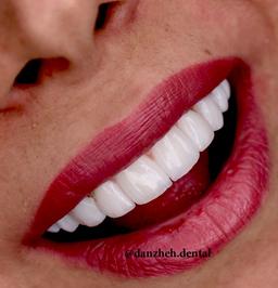 طرح لبخند لمینتی  و کامپوزیتی چیست