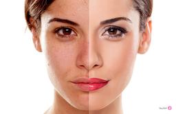 راه‌های جالب برای سفید کردن پوست آفتاب سوخته