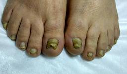 درمان قارچ ناخن