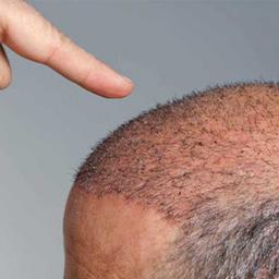 قیمت کاشت مو