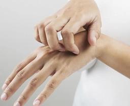 درمان خانگی اگزما