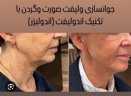 چرا تو 45 سالگی به فکر اندولیفت صورت افتادم؟تجربه‌ای که انتظارش را نداشتم