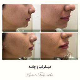 تجربه من از تزریق فیلر لب با سونوگرافی
