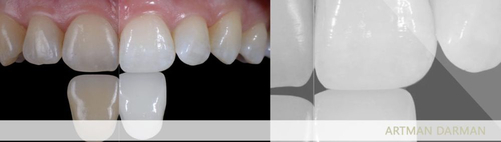 آفیس بلیچینگ چیست و چه تفاوتی با هوم بلیچینگ دارد؟