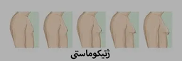 ژنیکوماستی یا بزرگی سینه در آقایان