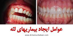 بیماری لثه را چگونه تشخیص دهیم؟