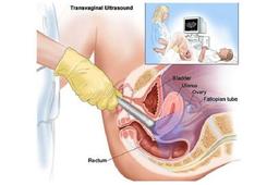 سونوگرافی واژینال چیست و چه کاربردی دارد؟