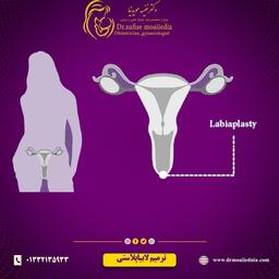 عمل ترمیم لابیاپلاستی چگونه است و برای چه افرادی انجام می‌شود؟