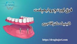 فرق اوردنچر و ایمپلنت دندان