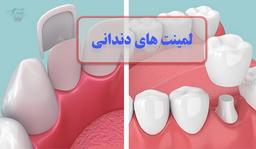 لمینت دندان چیست و کجا کاربرد دارد؟