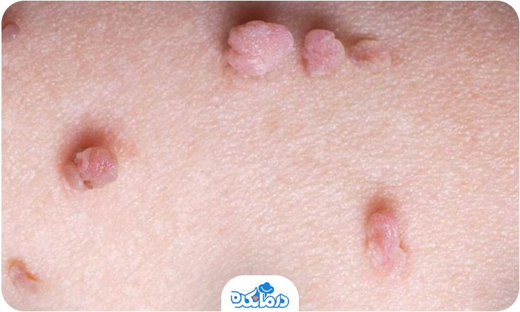 تصویری از زائده‌های گوشتی و برجستگی‌ بر روی پوست که نشان از زگیل تناسلی است.