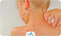 درمان خارش آبله مرغان در طب سنتی؛ 7 راهکار موثر برای درمان آن