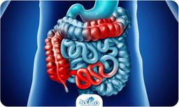 بیماری کرون؛ علل، علائم، راه‌کارهای درمان و پیشگیری