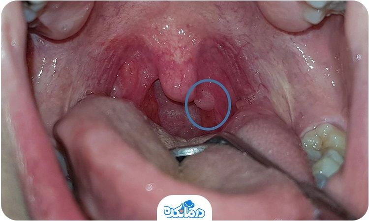 زگیل دهانی میتواند نقاط مختلف دهان را تحت تاثیر قرار دهد.