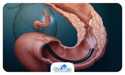 کولونوسکوپی برای تشخیص چه بیماری هایی است و چگونه انجام می‌شود؟