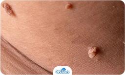 زگیل تناسلی مردان؛ راه‌های انتقال، درمان و پیشگیری