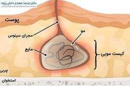 تا حالا اسم کیست مویی به گوشتون خورده؟