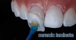 لمینت سرامیکی