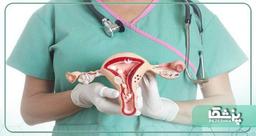 راه های درمان کیست تخمدان چیست؟