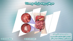 طول عمر بیماران مبتلا به سرطان روده