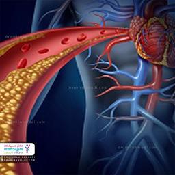 همه چیز درباره بیماری‌های عروق کرونر