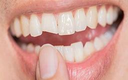 انواع شکستگی دندان و روش های ترمیم دندان شکسته