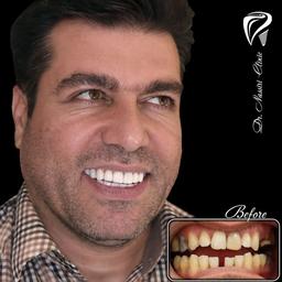 انواع لمینت دندان برای چه افرادی مناسب است؟