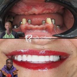 ایمپلنت دندان جلو یا بریج دندان؟ کدام بهتر است؟