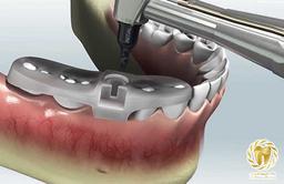 مزایای ایمپلنت دیجیتال