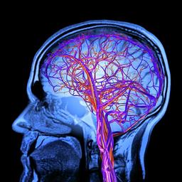 دمانس عروقی چیست؟