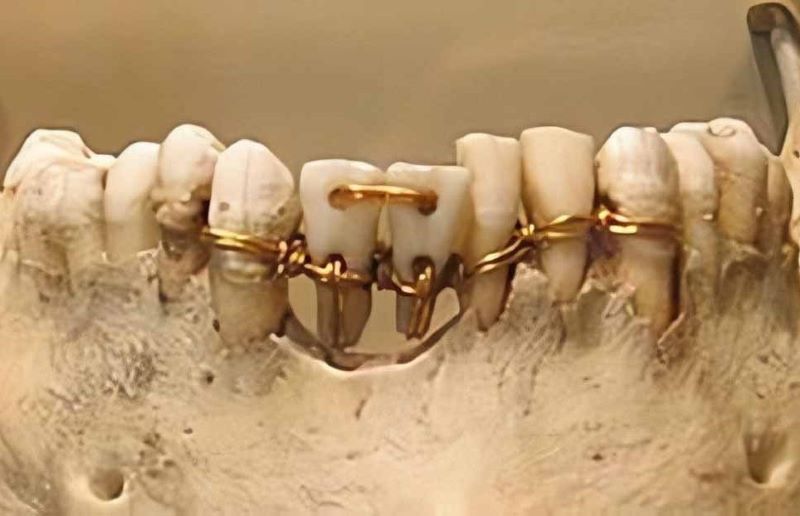 فسیل دندان از قرون وسطی