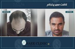 طبیعی‌ترین روش کاشت مو در ایران