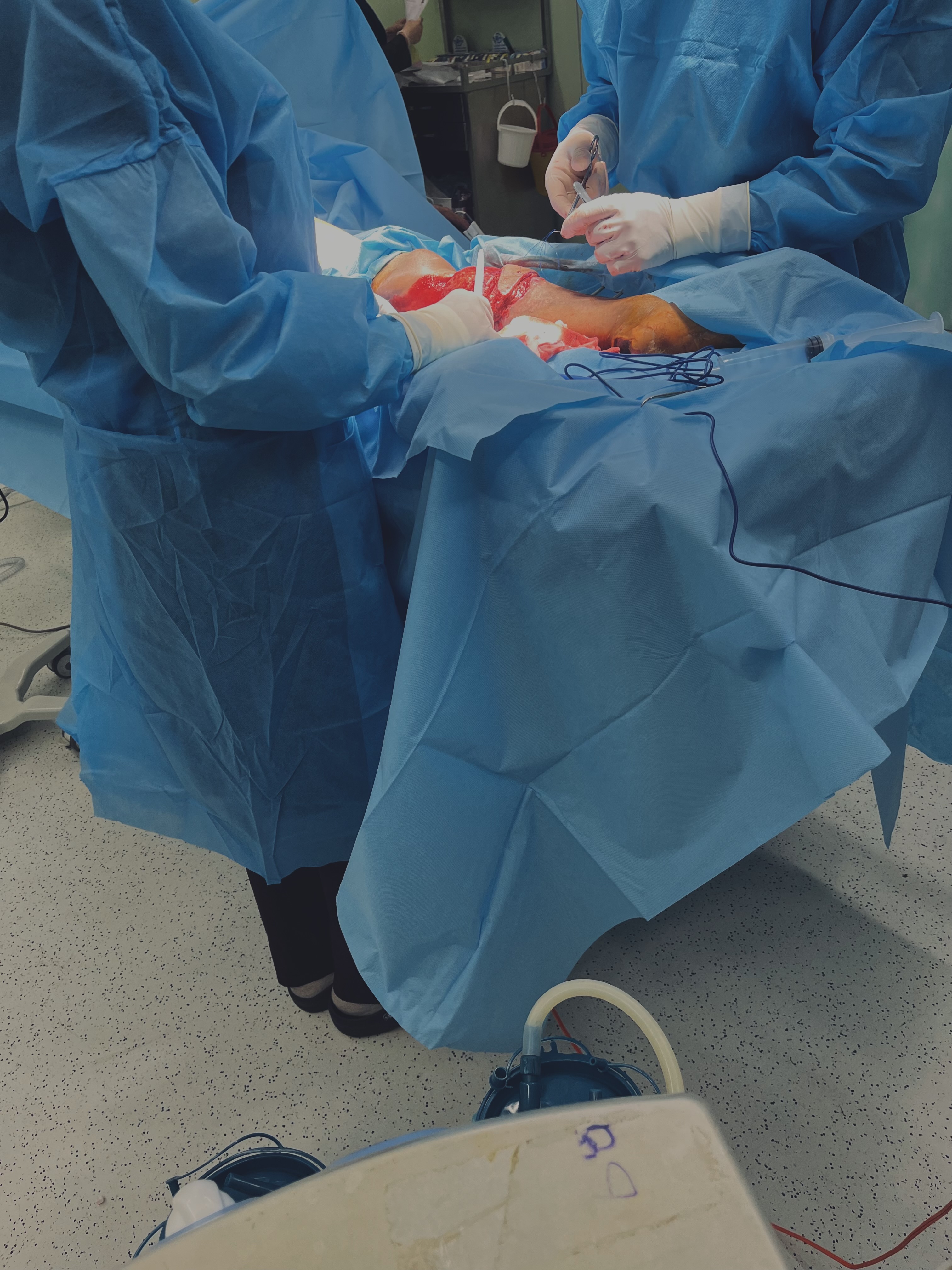 کلینیک المهدی-اتاق عمل پلاستیک-پیوند پوست از ران پا به ساق..