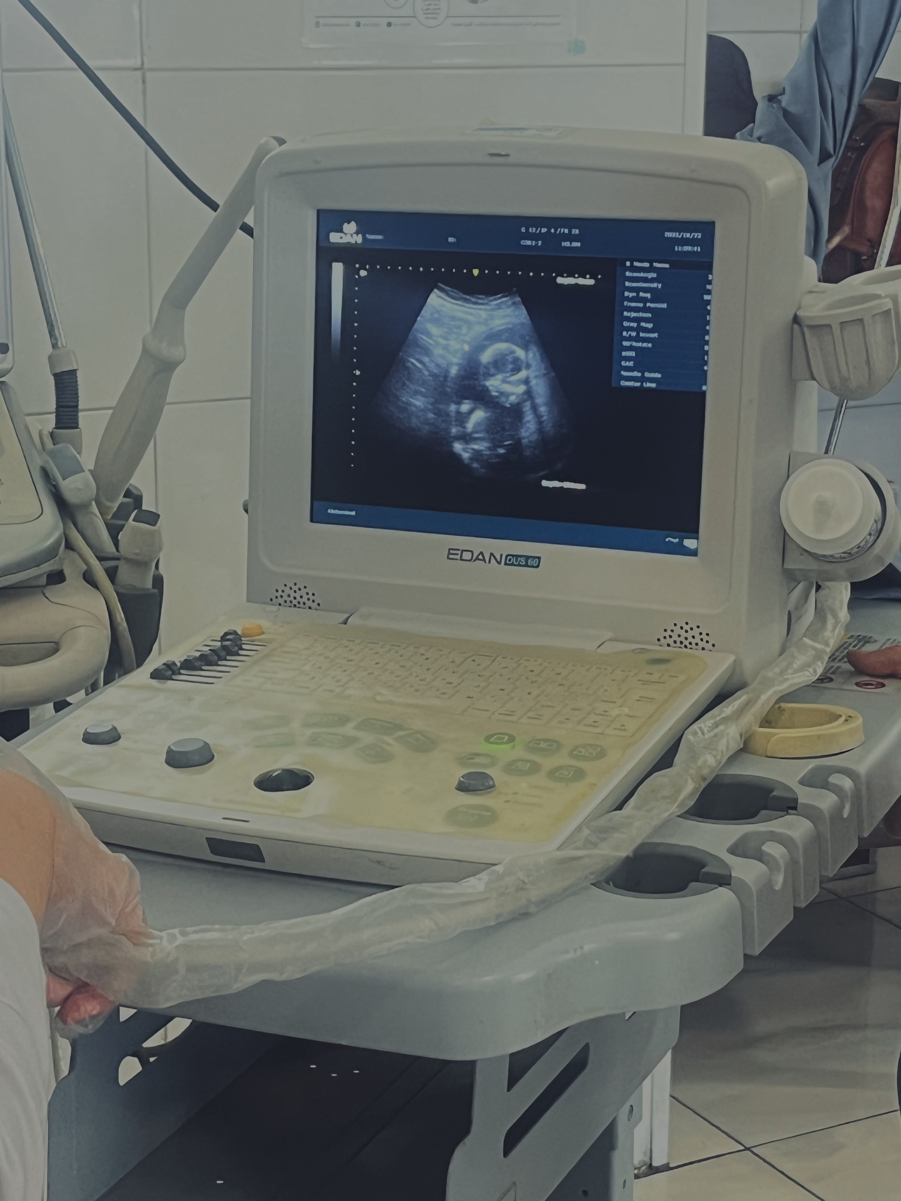 بیمارستان ولیعصر-بخش لیبر-سونوگرافی مادری که به دلیل سندرم داون جنین،ختم بارداری اعلام شد..