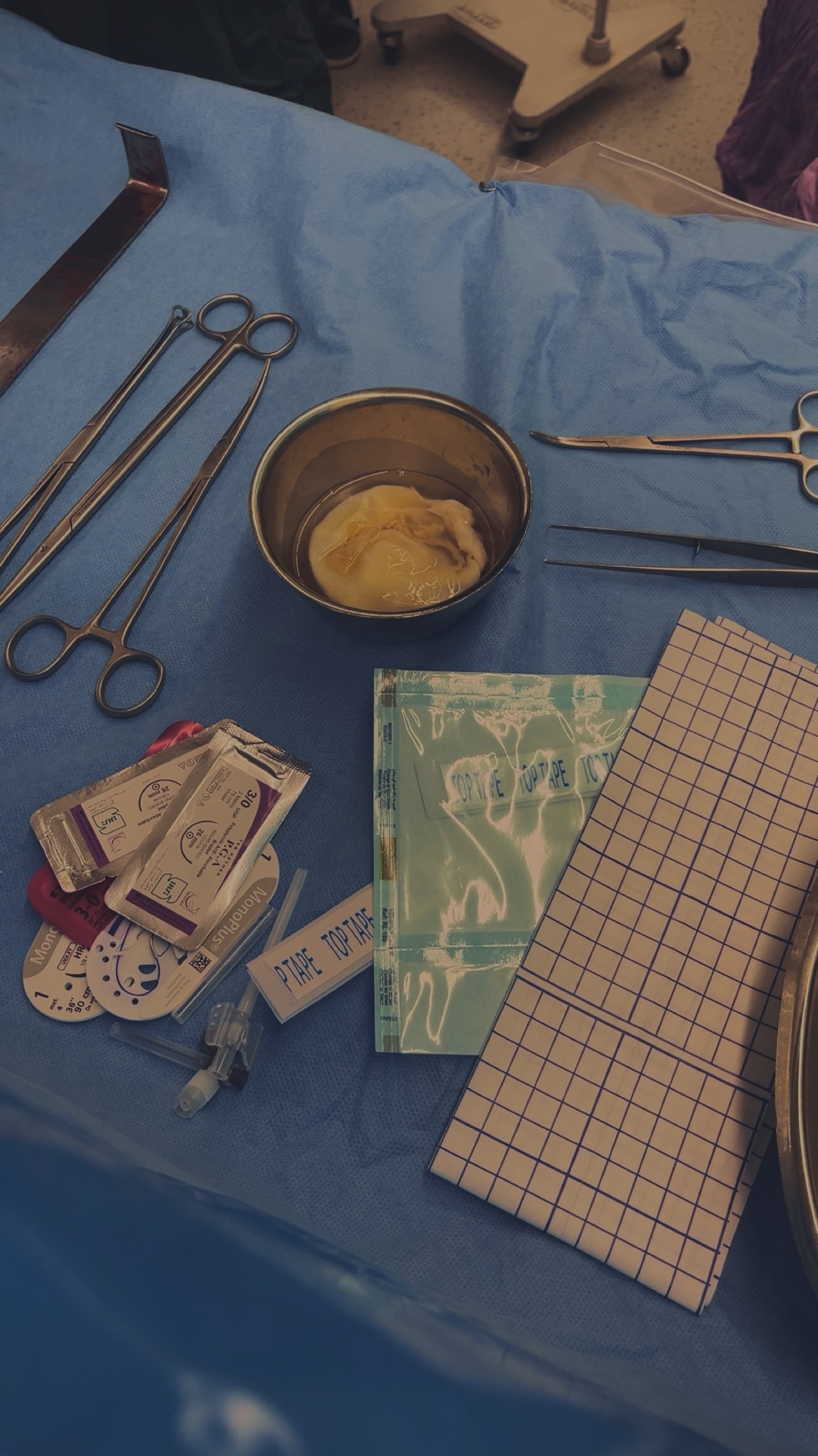 کلینیک المهدی-اتاق عمل توراکس(ریه)-عمل برداشت کیست هیداتیک داخل ریه(این یک کیست انگلی هست که انگلش از طریق خوردن سبزیجات نشسته وارد بدن میشه..)