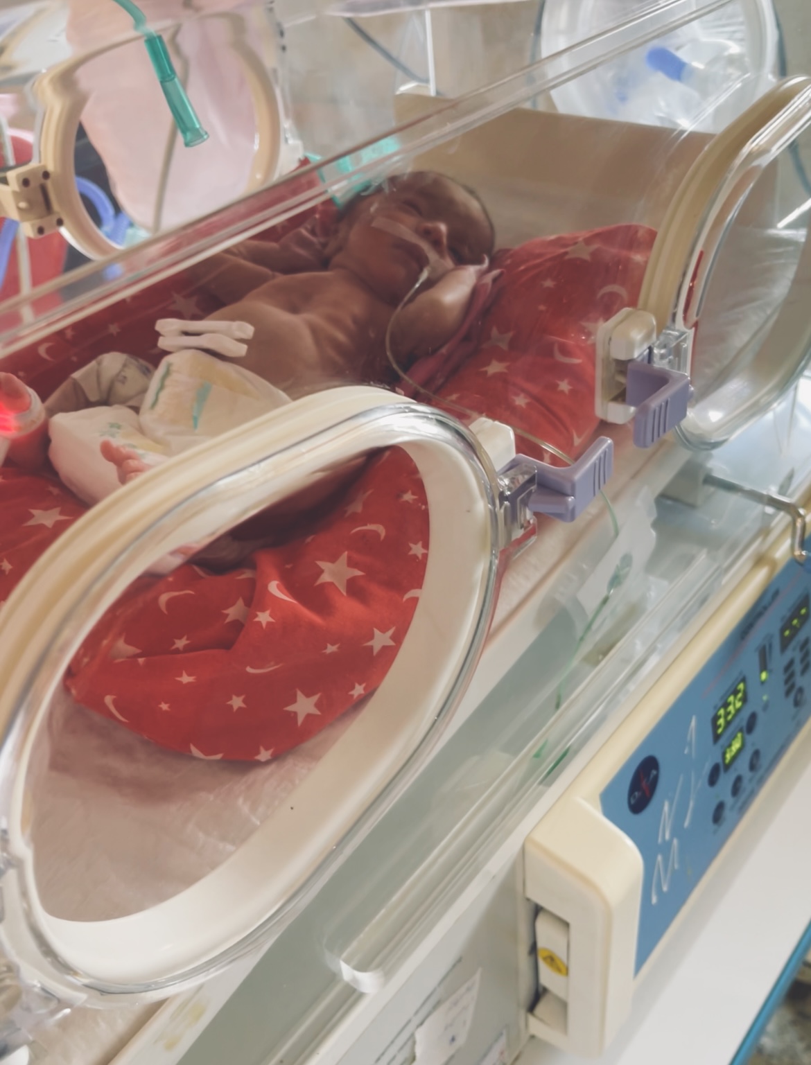 بیمارستان ولیعصر-NICU-نوزاد چند روزه بستری به دلیل سندرم زجر تنفسی-دنده هاش و..