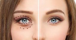 بلفاروپلاستی چگونه انجام می شود؟